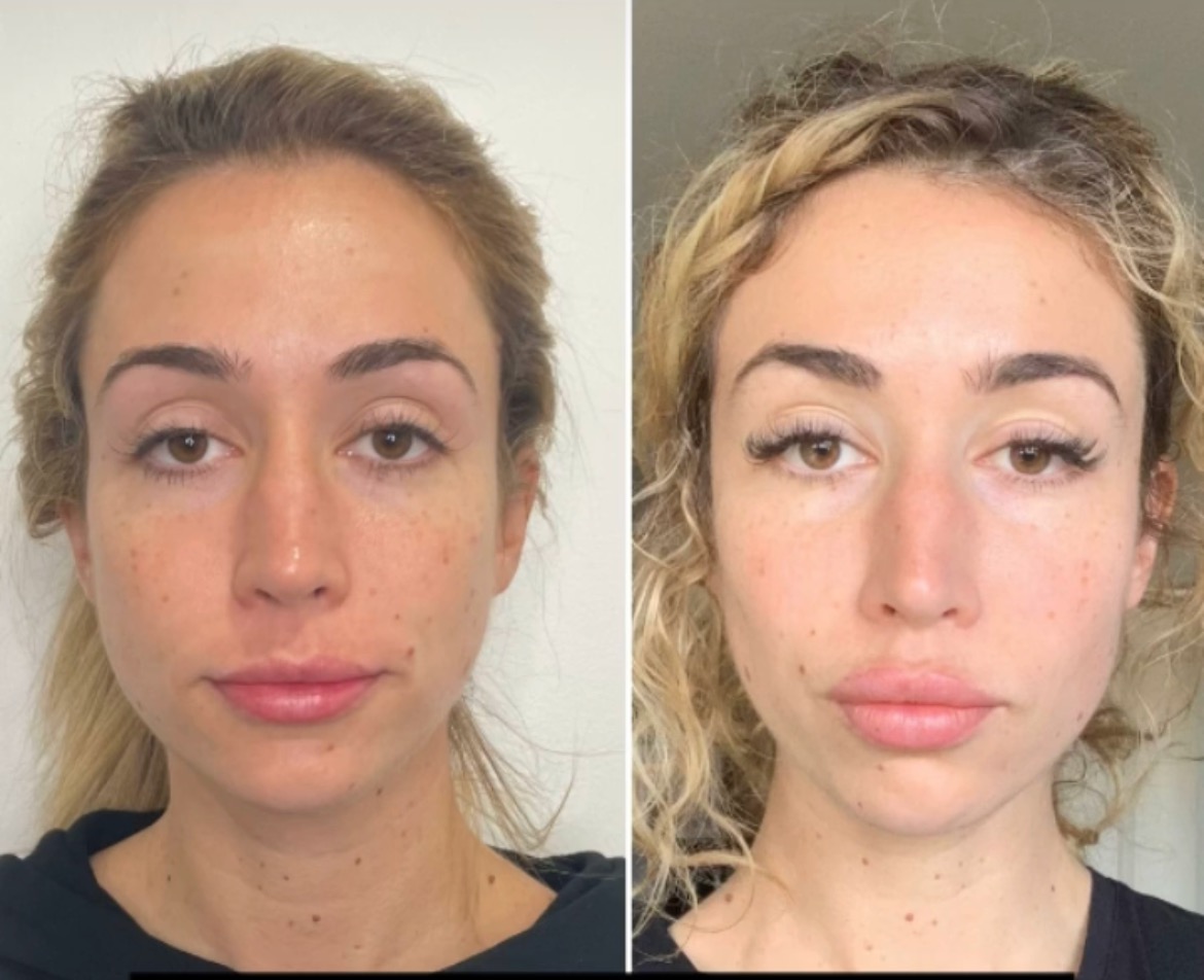 https://www.theperfectdose.com/wp-content/uploads/2024/10/Non-surgical-facelift-bxa2.jpg